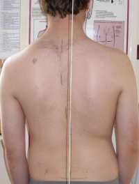 Scoliosis Treatment May 2009