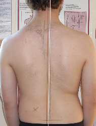 Scoliosis Treatment July 2009