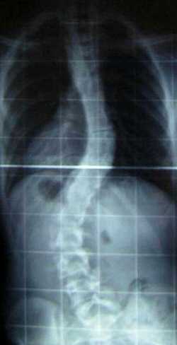 The Xray of a Scoliosis Patient Prior to Surgery